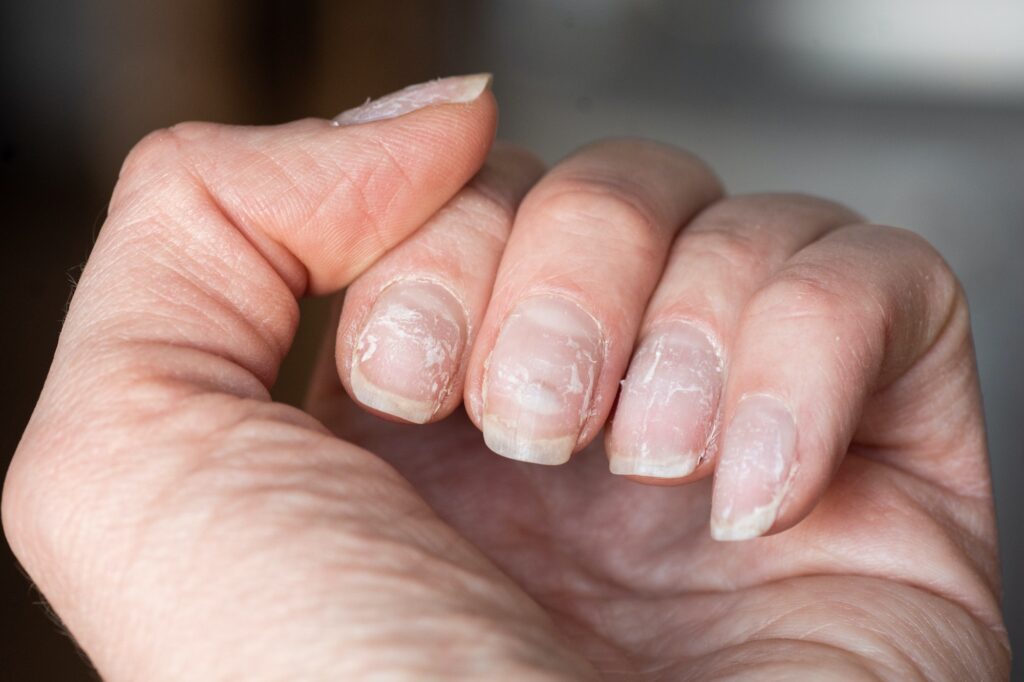 Close-up of brittle nails. Damage to nail after using shellac or gel polish. Peeling on the nails