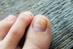 210707-The-Foot-Practice-Prevent-Toenail-Fugus