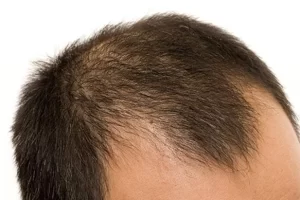 24515-male-pattern-baldness