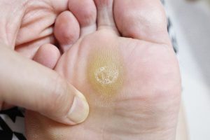 Whats-the-Differences-Between-Foot-Corns-vs-Foot-Calluses-600x400