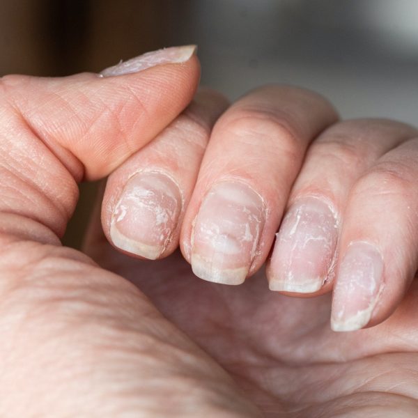 Close-up of brittle nails. Damage to nail after using shellac or gel polish. Peeling on the nails