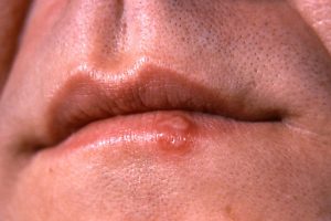 herpes-on-lips-image-credit-cdc-dr-hermann-1964