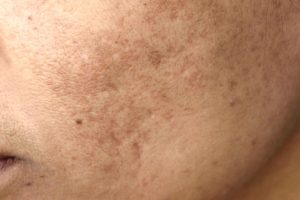 melasma